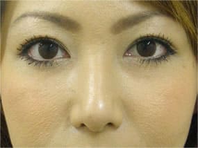 目の下のクマ・タルミ症例手術３ヶ月後