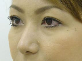 目の下のクマ・タルミ症例手術前