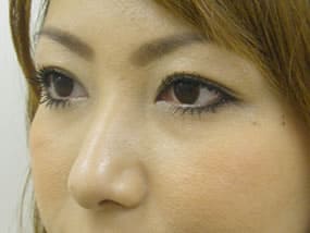 目の下のクマ・タルミ症例手術３ヶ月後