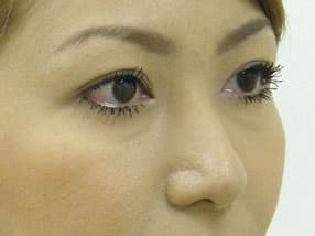 目の下のクマ・タルミ症例手術前