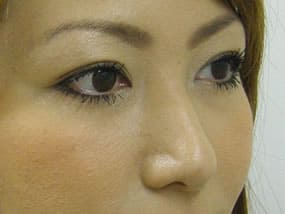 目の下のクマ・タルミ症例手術３ヶ月後