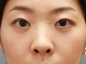 目の下のクマ・タルミ症例手術１ヶ月後（メイクあり）