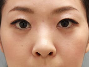 目の下のクマ・タルミ症例手術２ヶ月後（メイクあり）