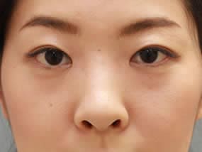 目の下のクマ・タルミ症例：手術前（メイクあり）