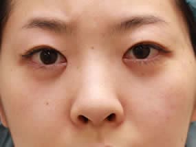目の下のクマ・タルミ症例：経結膜脱脂直後（メイクなし）