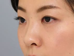 目の下のクマ・タルミ症例手術前