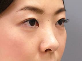 目の下のクマ・タルミ症例手術前