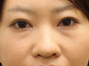 目の下のクマ・タルミ症例手術前（メイクあり）