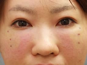 目の下のクマ・タルミ症例手術直後（メイクなし）