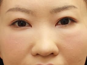 目の下のクマ・タルミ症例手術１週間後（メイクあり）