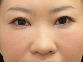 目の下のクマ・タルミ症例手術２週間後（メイクあり）
