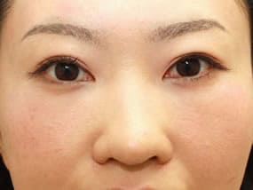 目の下のクマ・タルミ症例手術１ヵ月後（メイクあり）