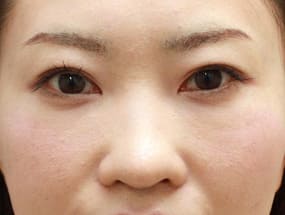 目の下のクマ・タルミ症例手術２ヶ月後
