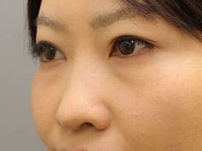 目の下のクマ・タルミ症例手術前