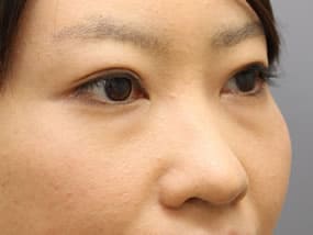 目の下のクマ・タルミ症例手術前