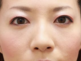 目の下のクマ・タルミ症例手術④脱脂＋脂肪注入後（メイクなし）