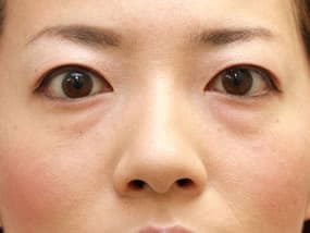 目の下のクマ・タルミ症例手術前