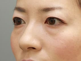 目の下のクマ・タルミ症例手術前