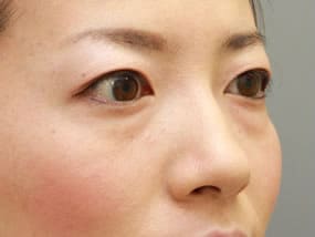 目の下のクマ・タルミ症例手術前