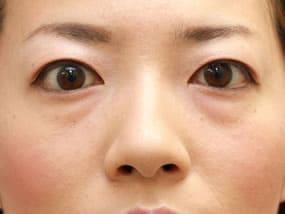 目の下のクマ・タルミ症例①手術前（メイクあり）