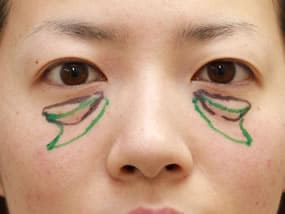 目の下のクマ・タルミ症例①-２手術前（メイクあり）