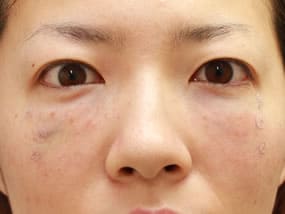 目の下のクマ・タルミ症例②手術デザイン（メイクなし）