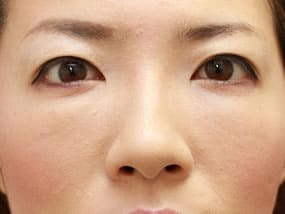 目の下のクマ・タルミ症例手術２週間後（メイクあり）