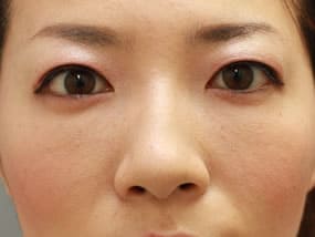 目の下のクマ・タルミ症例手術③脱脂のみ終了後（メイクなし）