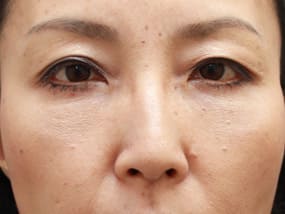 目の下のクマ・タルミ症例手術３ヶ月後（メイクあり）