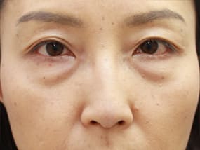 目の下のクマ・タルミ症例手術前（メイクあり）