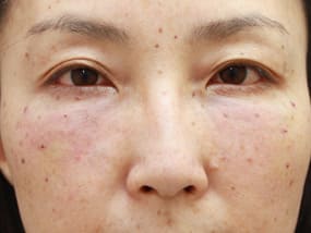 目の下のクマ・タルミ症例手術直後（メイクなし）