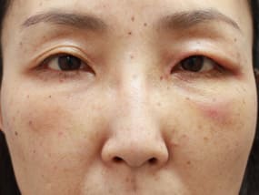 目の下のクマ・タルミ症例手術３日後（メイクあり）