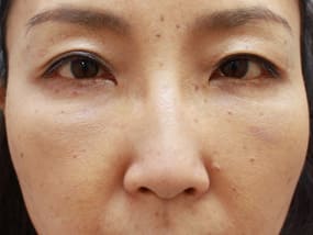 目の下のクマ・タルミ症例手術１週間後（メイクあり）