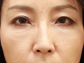 目の下のクマ・タルミ症例手術１ヵ月後（メイクあり）