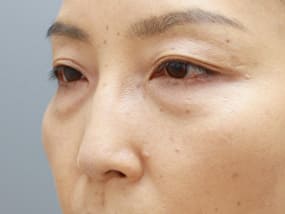 目の下のクマ・タルミ症例手術前