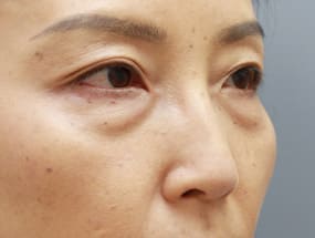 目の下のクマ・タルミ症例手術前