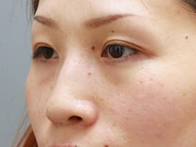 目の下のクマ・タルミ症例手術前