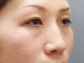 目の下のクマ・タルミ症例手術前