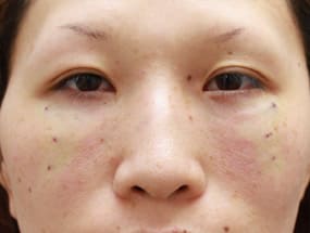 目の下のクマ・タルミ症例②手術デザイン