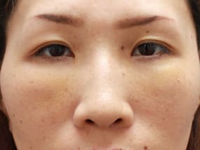 目の下のクマ・タルミ症例手術③手術直後
