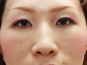 目の下のクマ・タルミ症例手術③-２手術直後