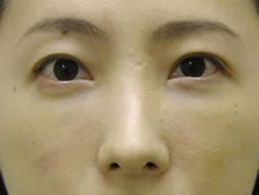 目の下のクマ・タルミ症例手術１週間後（メイクあり）
