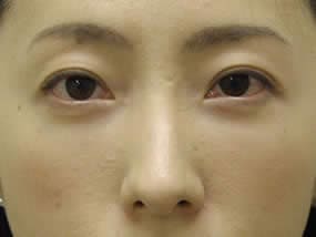 目の下のクマ・タルミ症例手術１ヵ月後（メイクあり）