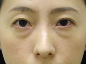 目の下のクマ・タルミ症例手術前