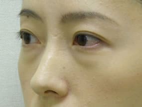 目の下のクマ・タルミ症例手術前