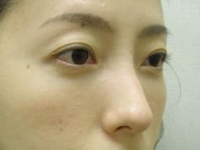 目の下のクマ・タルミ症例手術３ヶ月後