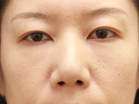目の下のクマ・タルミ症例⑧手術１ヵ月後（メイクあり）