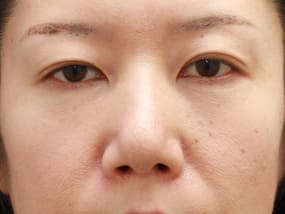 目の下のクマ・タルミ症例⑨手術２ヵ月後（メイクあり）
