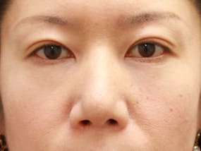 目の下のクマ・タルミ症例⑩手術３ヵ月後