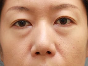 目の下のクマ・タルミ症例手術前